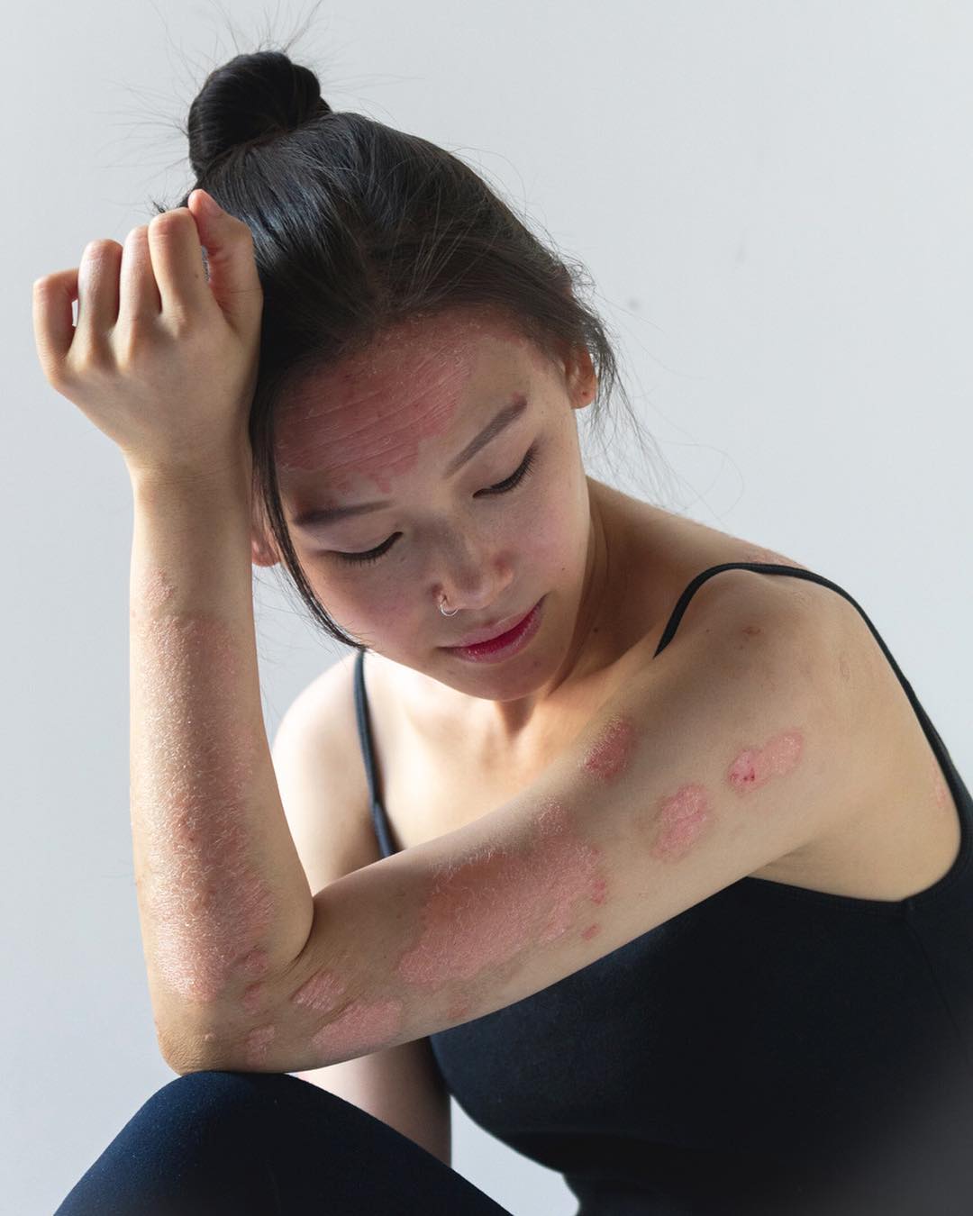 Growing up with psoriasis was not easy.